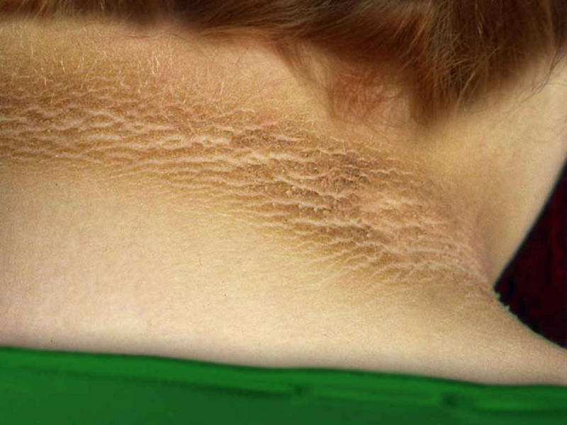 Warning sign Photo of a person’s neck, showing darkly pigmented area.