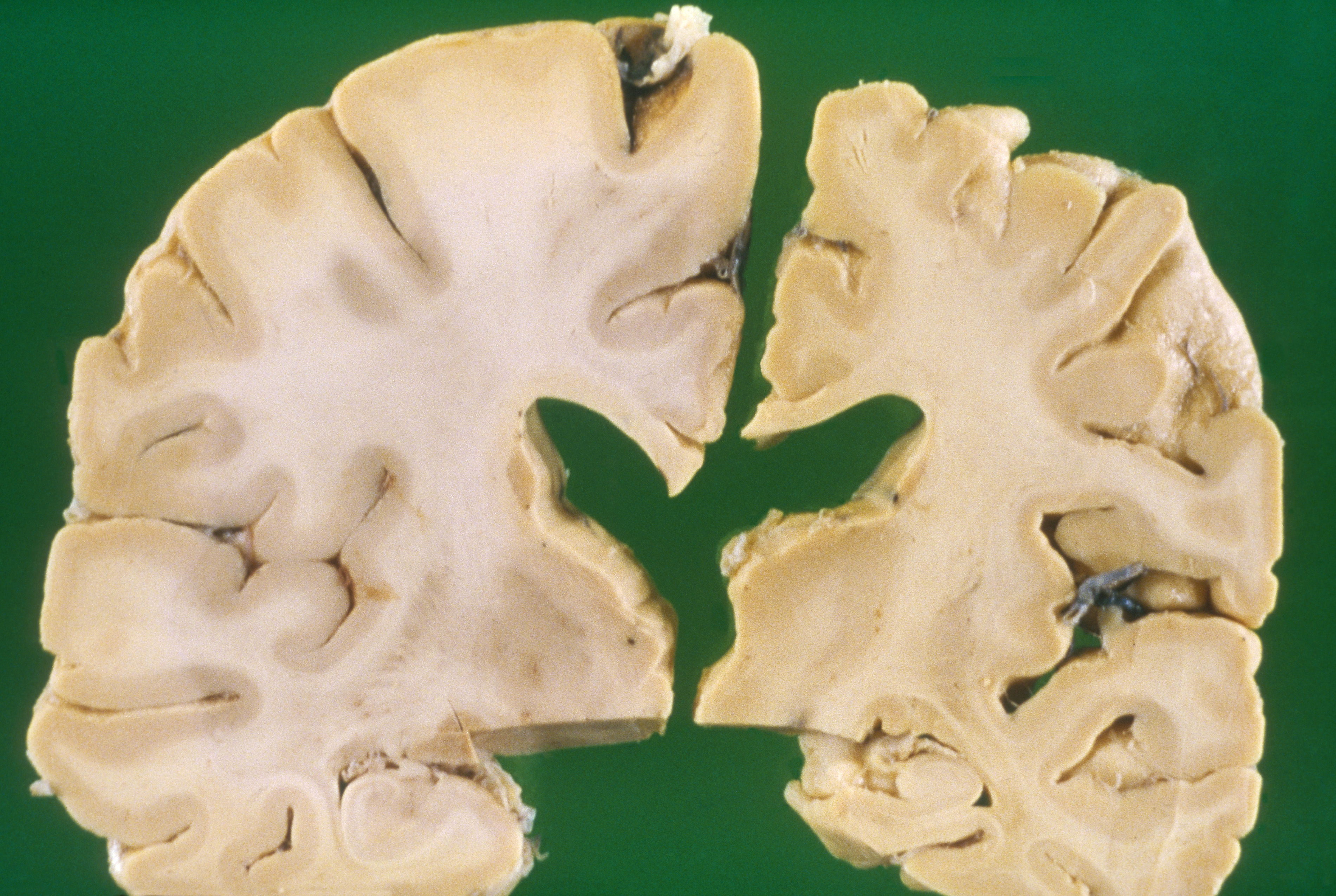 A slice of brain from an Alzheimer’s patient A slice of brain from an Alzheimer’s patient is compared to a slice from a normal adult.