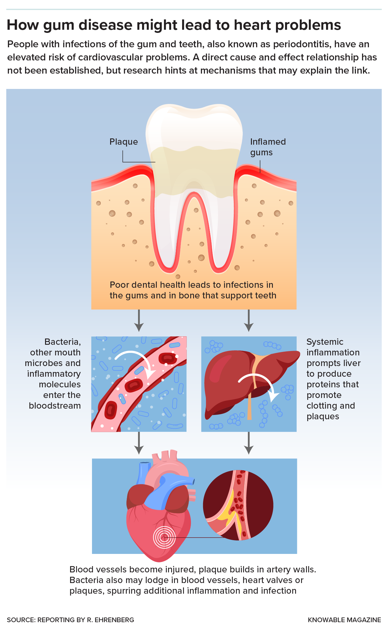 Gum disease and heart disease Graphic shows how chronic inflammation in the mouth, and oral bacteria, could lead to cardiovascular problems.