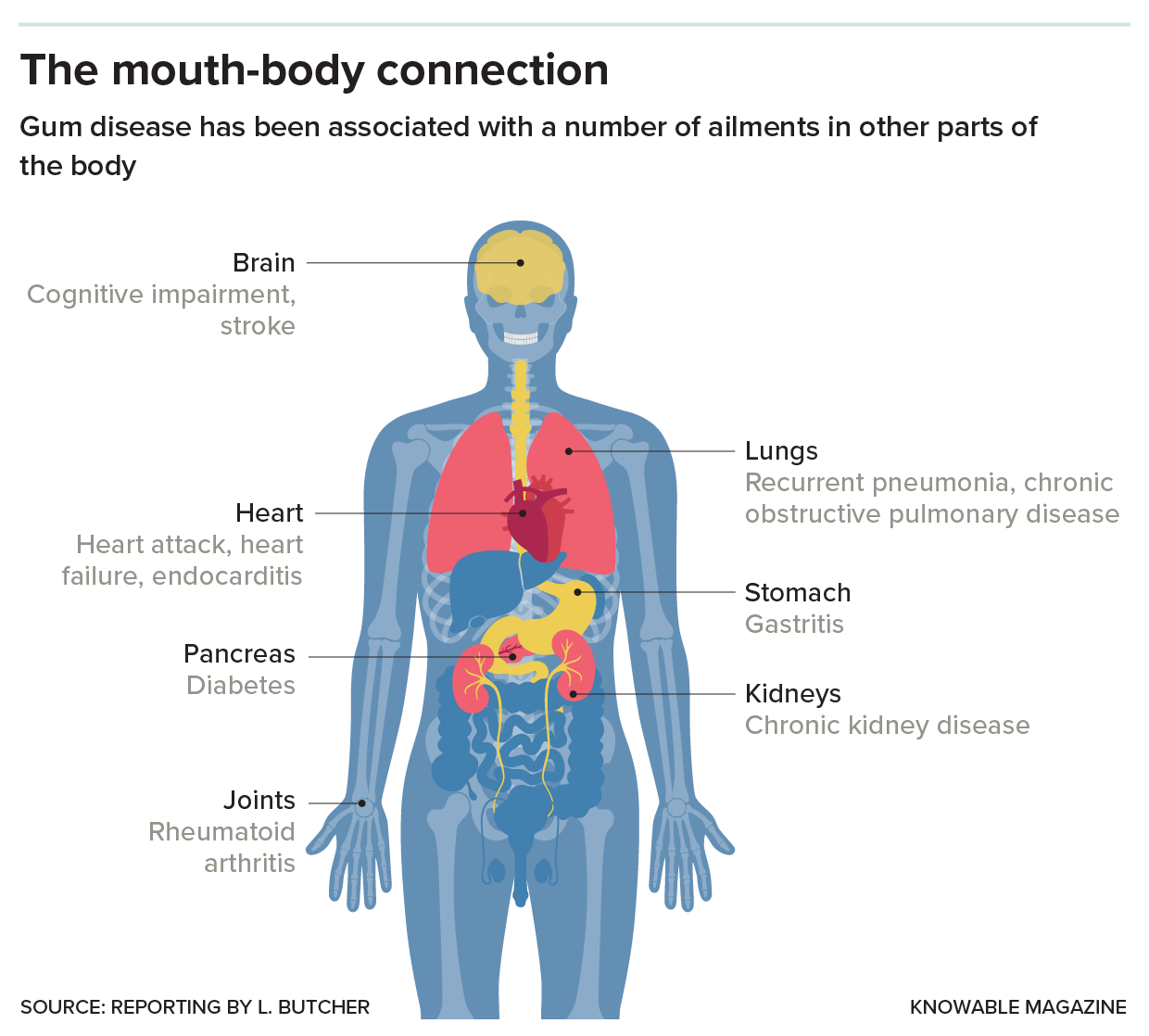 Gum disease's long reach Diagram of a body highlighting the various organs affected by poor dental health